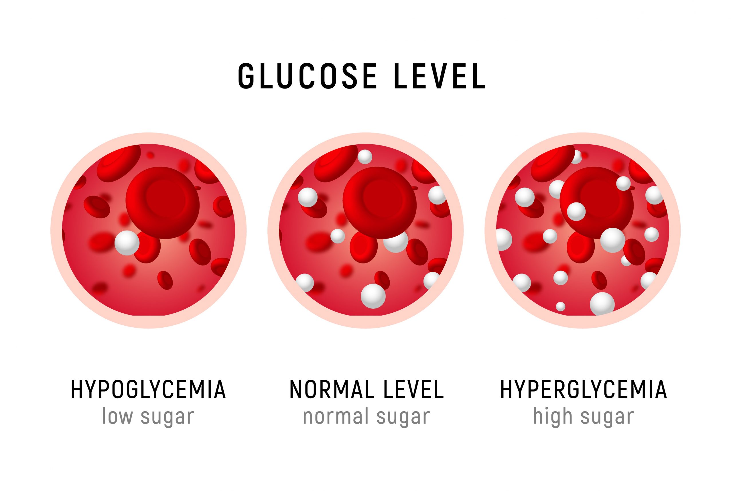 Image showing hypoglycemia (low blood sugar), normal blood sugar, and hyperglycemia (high blood sugar)