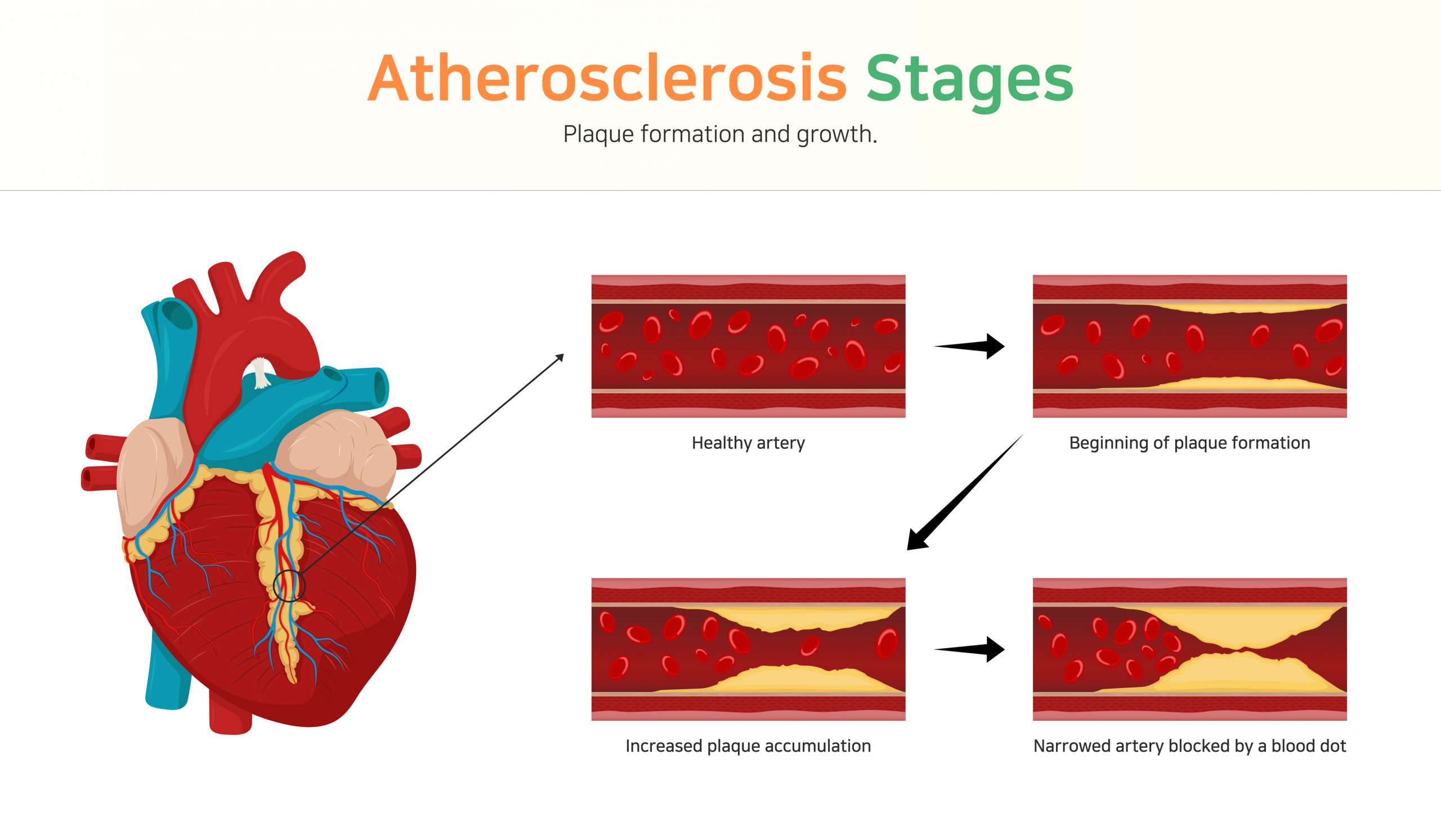 Image showing how an artery changes from a healthy artery that blood can flow through to an artery blocked with plaque.