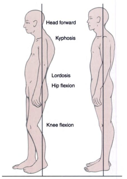 Decline of spinal flexibility greatest with age shown in older adult to left compared to aligned posture in younger adult to right.