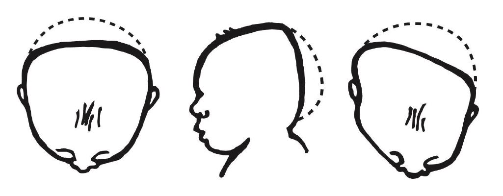 Brachycephaly drawings show a flattened, symmetrical head. Plagiocephaly shows asymmetrical flattening of the skull.