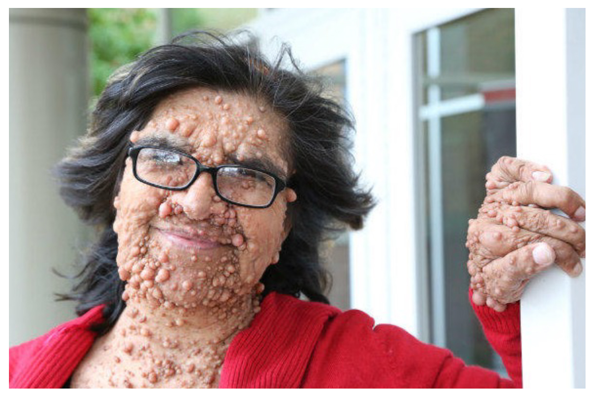 A woman has dozens of round, skin-colored tumors visible on her face, neck, and hand.