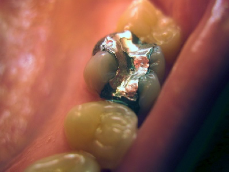 Four teeth in a person’s mouth. First molar with silver filling.