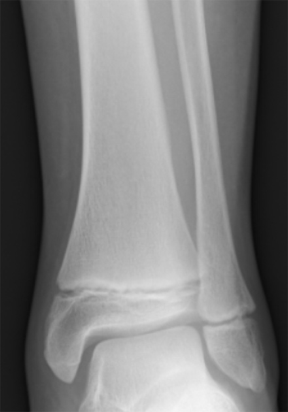 X-ray image of child’s ankle.