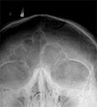 Radiograph of skull with frontal sinuses visible.