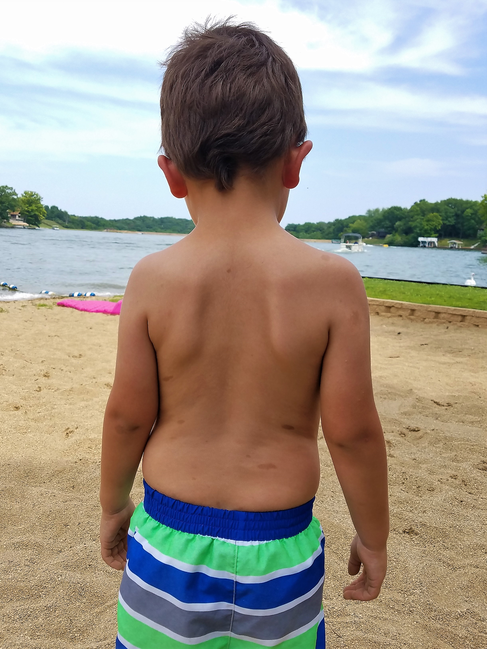 A child with darker oval birthmarks scattered across his torso and arms.