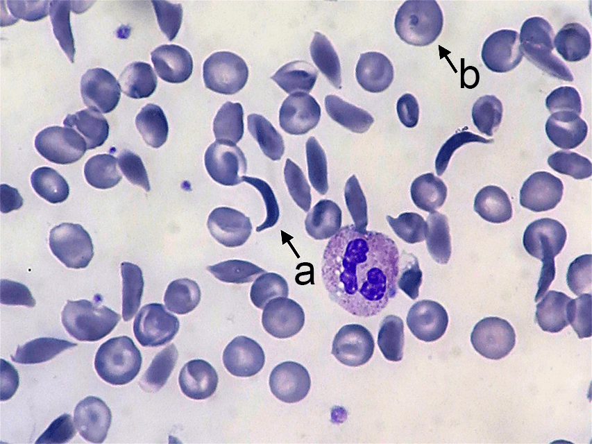 Round and sickle cells.