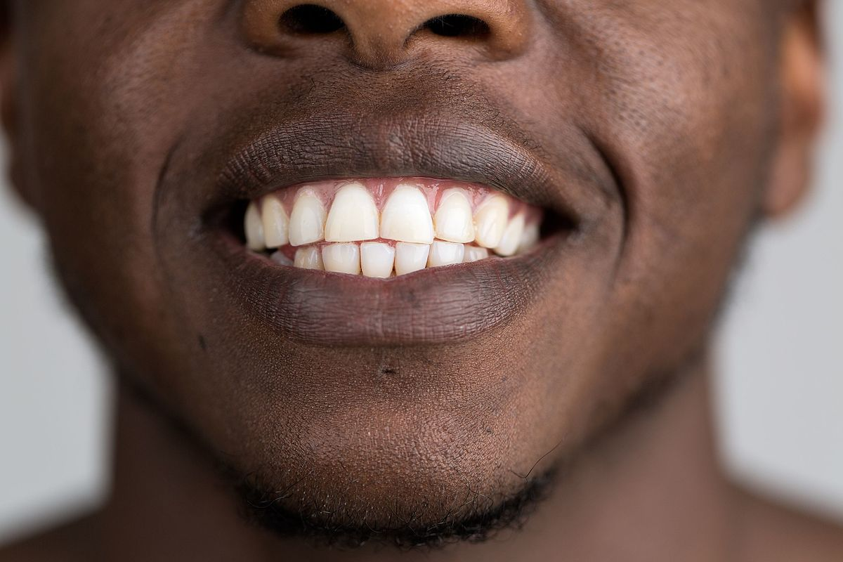 Anterior view of the lower face of a person showing their teeth.
