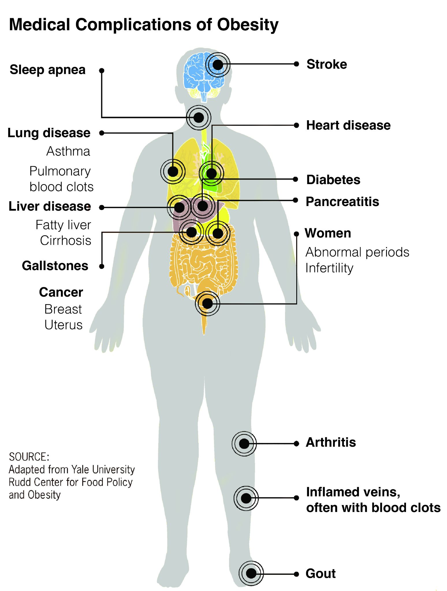 A human body outline with multiple points, each listing related medical complications.