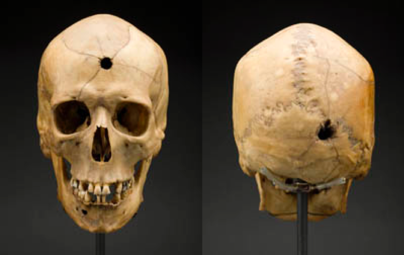 Anterior and posterior views of a skull with a gunshot wound.