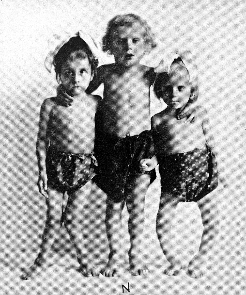Historic photo of three young children each with visible lower limb curvature.